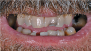Situación clínica inicial del paciente con compromiso periodontal avanzado y movilidad severa de las piezas dentales. Evaluación radiológica previa al tratamiento para el análisis del volumen óseo y la planificación de implantes.