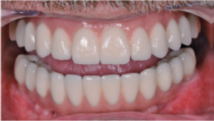 Resultado estético final tras la colocación de la prótesis definitiva, a un paciente con línea de sonrisa alta, sin compromiso visual de los accesos de tornillo.