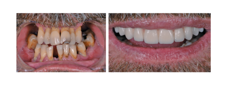 Caso clínico publicado en Dentale Implantologie (2019): “Estética y función con canales angulados”